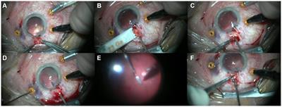 T-shaped pars plana scleral incision to remove large intraocular foreign body